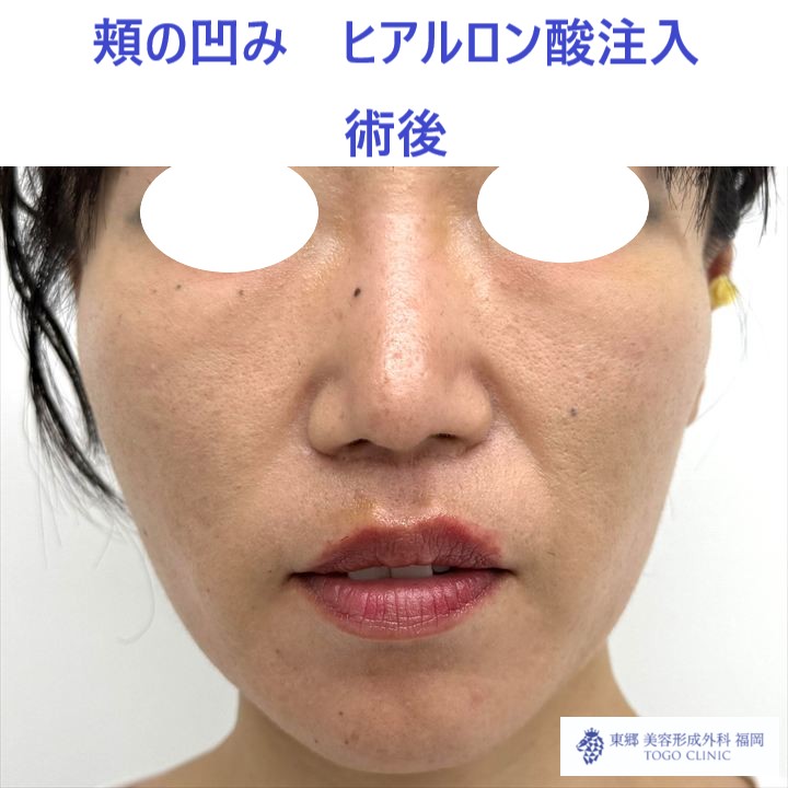 MO　頬HA術後