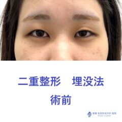 YY　埋没法　術前