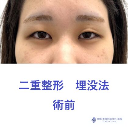 YY　埋没法　術前