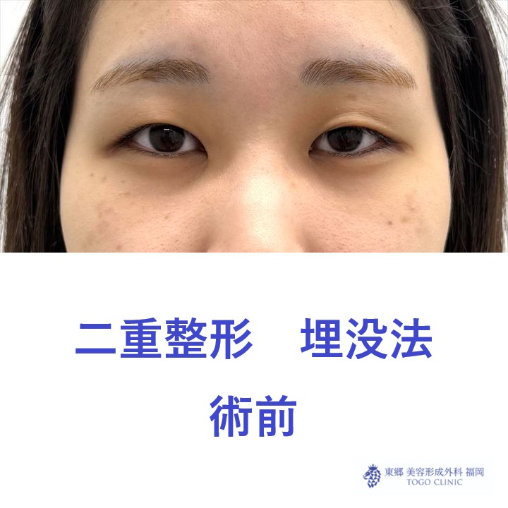 YY　埋没法　術前