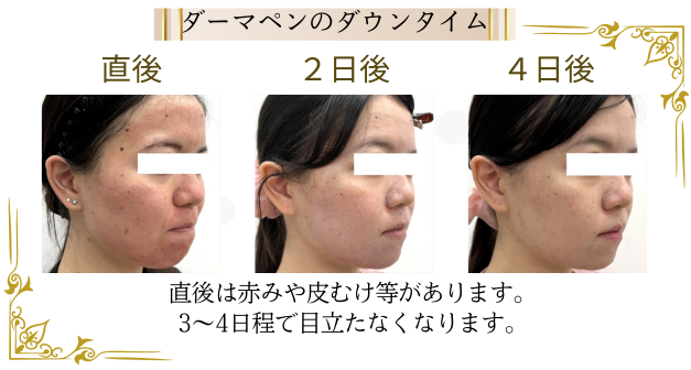 ニキビ跡や皮膚の凹凸に効果的なダーマペンのダウンタイム