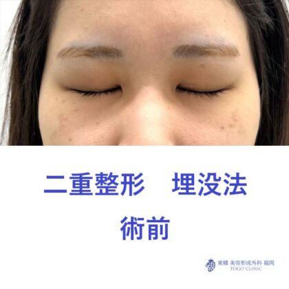 YY　埋没法　術前 (2)