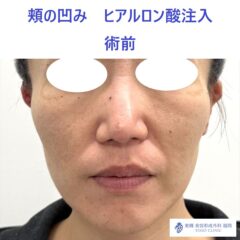 MO　頬HA術前