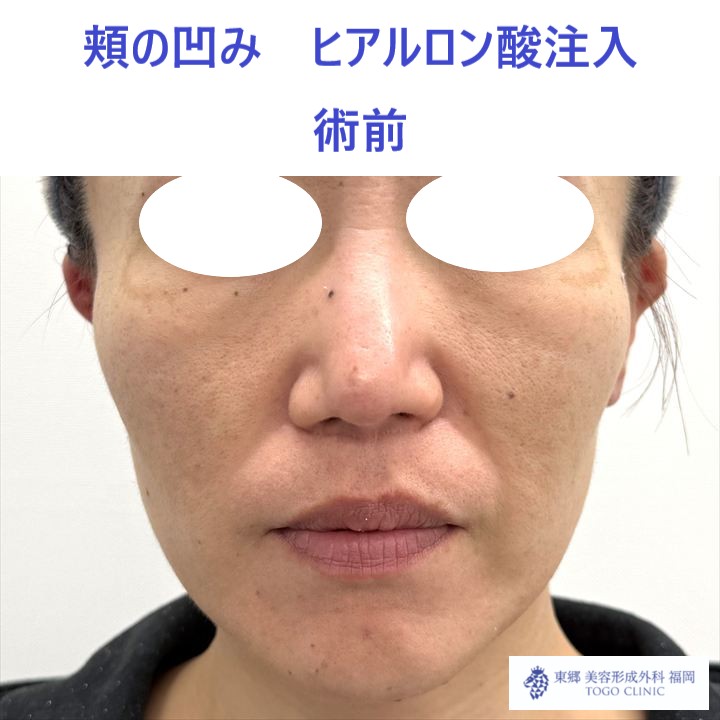 MO　頬HA術前