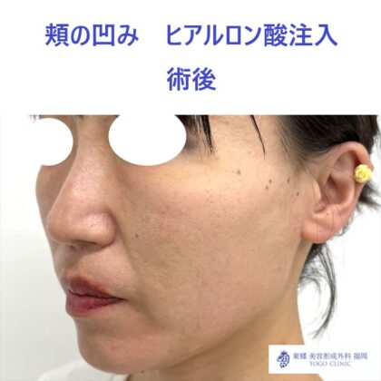 MO　頬HA術後 (2)