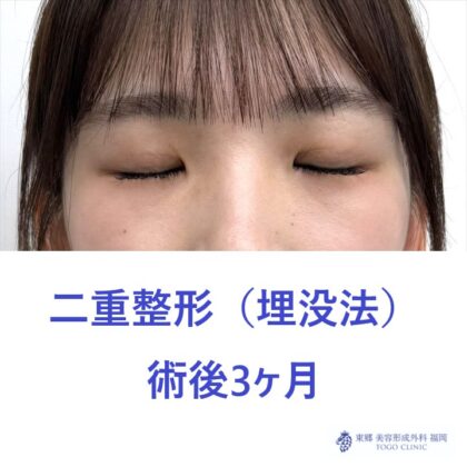 AH埋没法術後 (2)