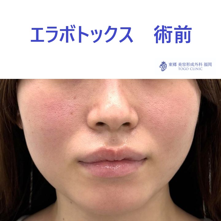 AO　エラボ　術前