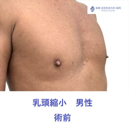 KH　乳頭縮小術前 (2)
