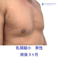 KH　乳頭縮小　術後