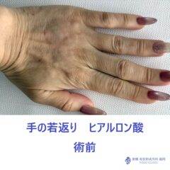 SK　手HA　術前 (2)