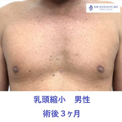 KH　乳頭縮小術後
