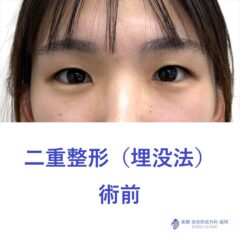 AH埋没法術前
