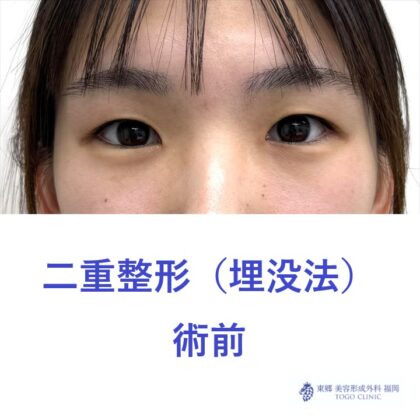 AH埋没法術前