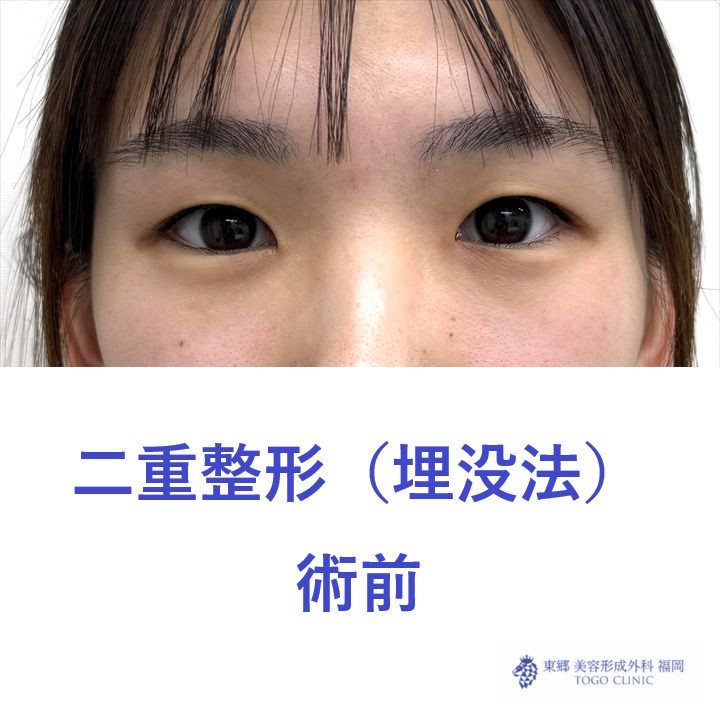 AH埋没法術前