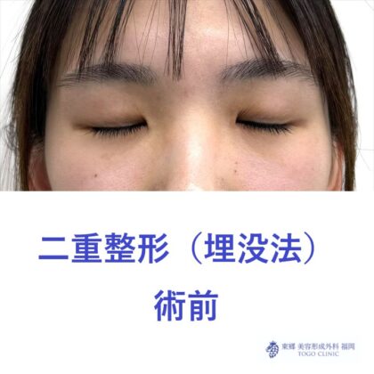 AH埋没法術前 (2)
