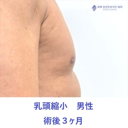KH　乳頭縮小術後 (2)