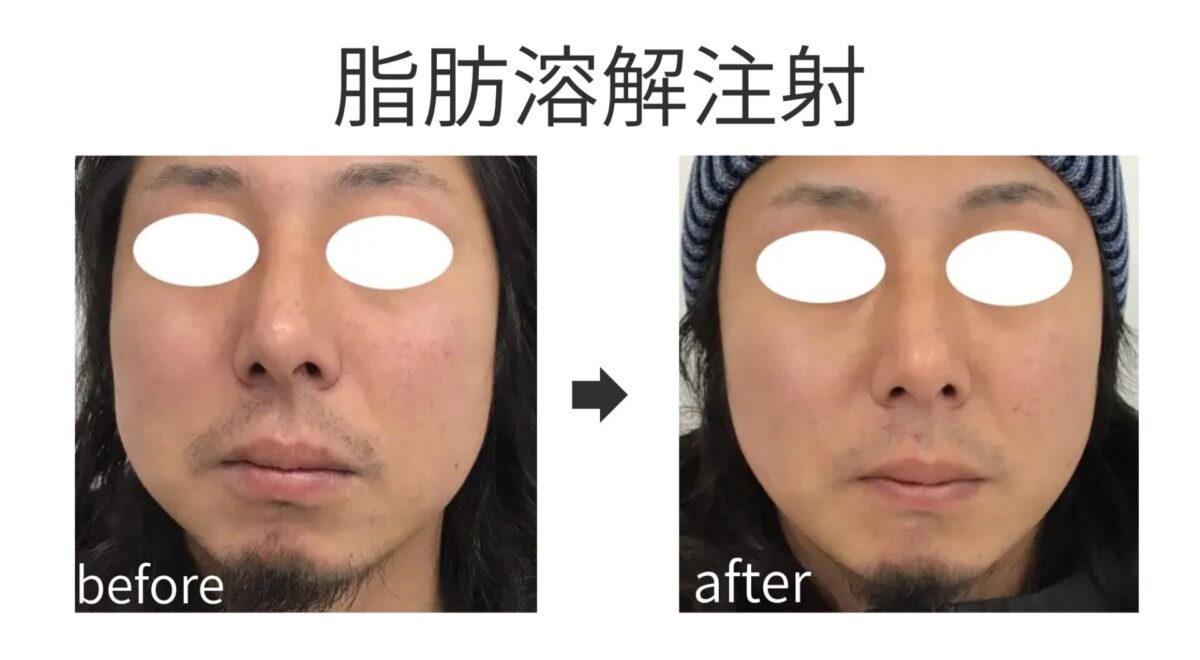 福岡で脂肪溶解注射