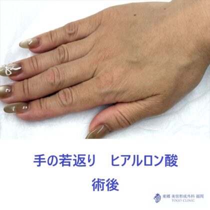 SK　手HA　術後