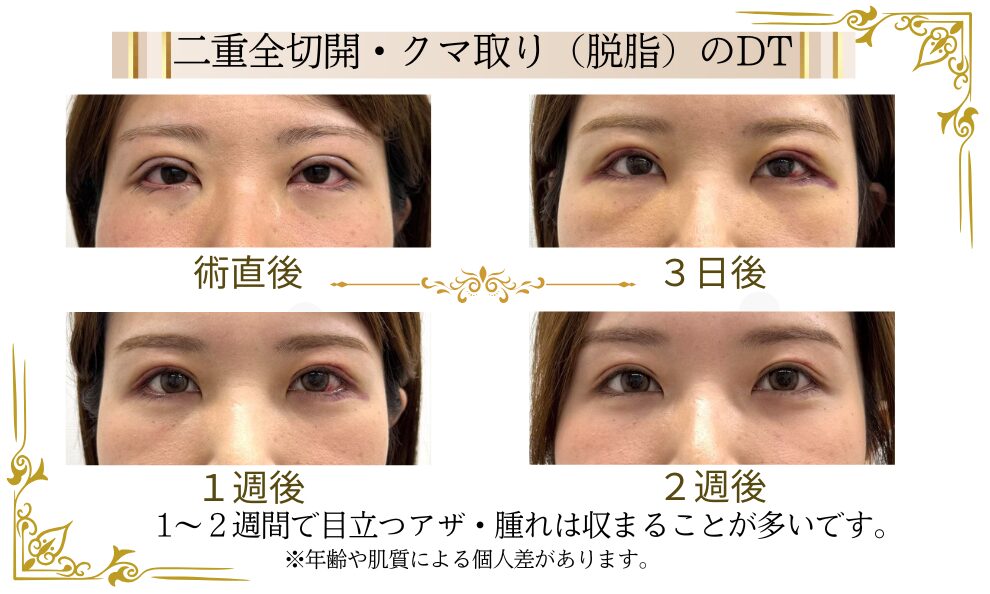 二重、目もとの手術の時間によるダウンタイムの経過