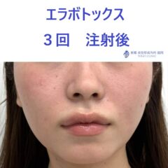 AO エラボ 術後.jpeg