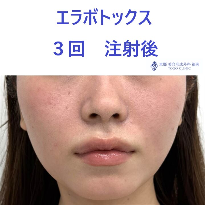 AO　エラボ　術後.jpeg