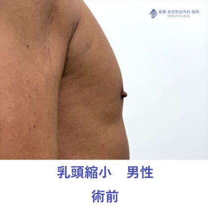 KH　乳頭縮小術前 (3)