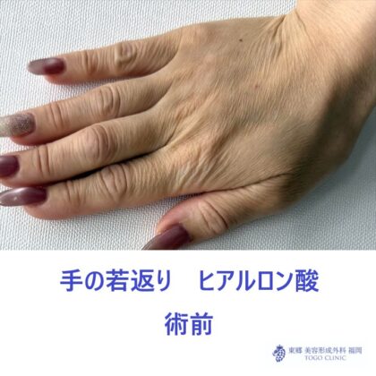 SK　手HA　術前