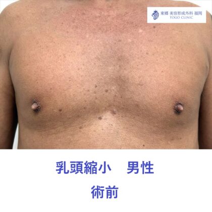 KH　乳頭縮小術前