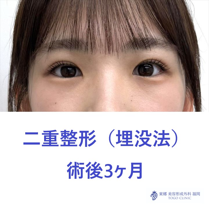 AH埋没法術後