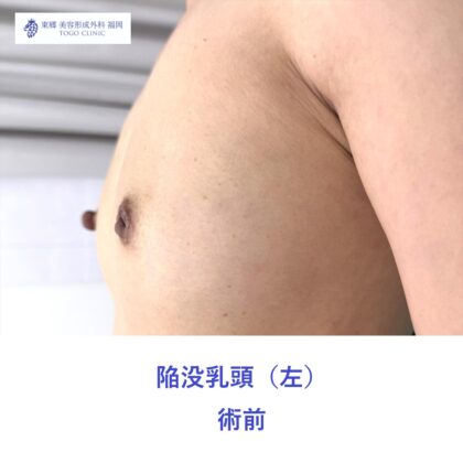 EK　陥没乳頭術前 (2)