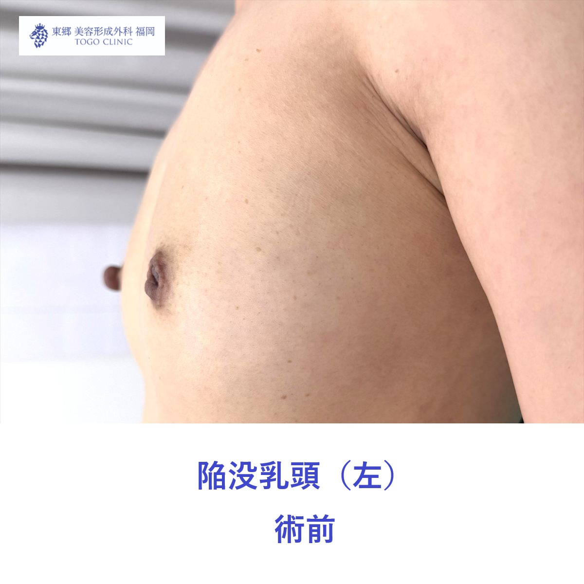 EK　陥没乳頭術前 (2)