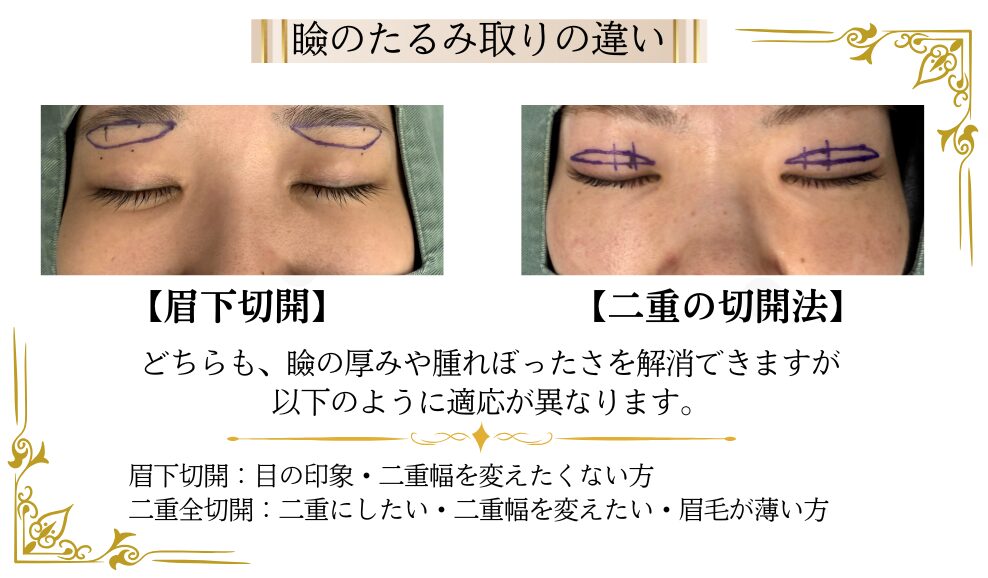 まぶたのたるみ取り（眉下切開と二重全切開）の違いと適応。目の印象や二重幅を変えずに厚み・腫れぼったさを解消する眉下切開と、二重幅変更・眉毛が薄い方に適した二重全切開の切除皮膚デザイン比較