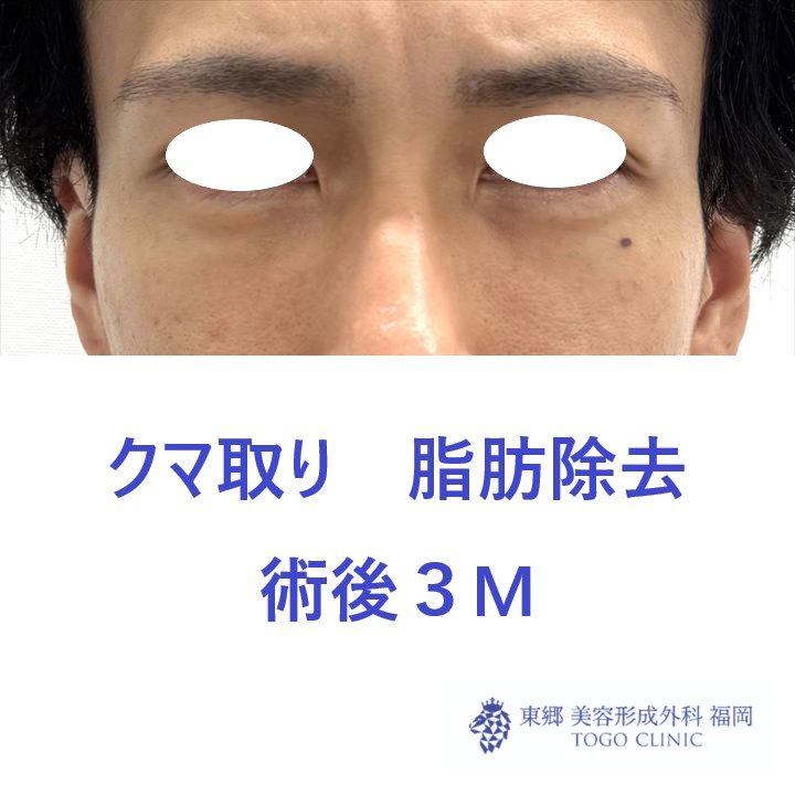 HM　経結膜術後