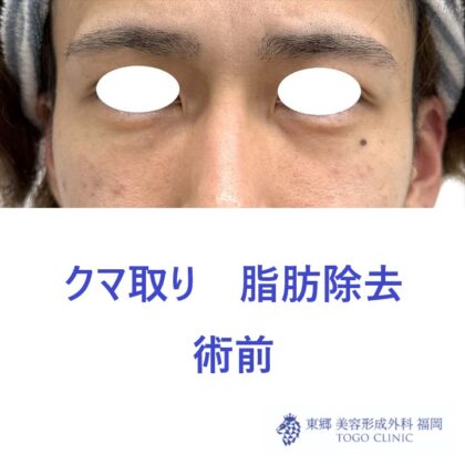 HM　経結膜術前