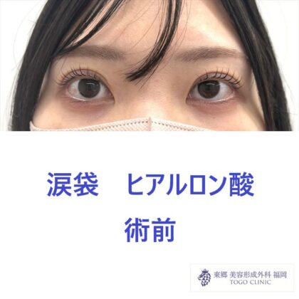 KO 涙袋　術前