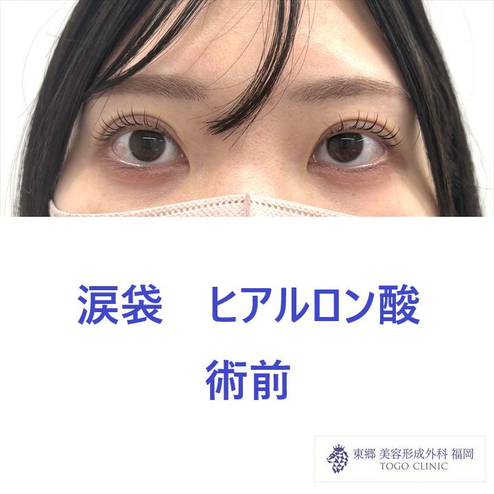KO 涙袋　術前