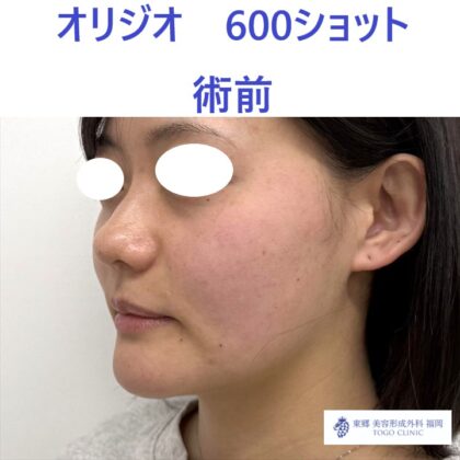 RFオリジオ術前
