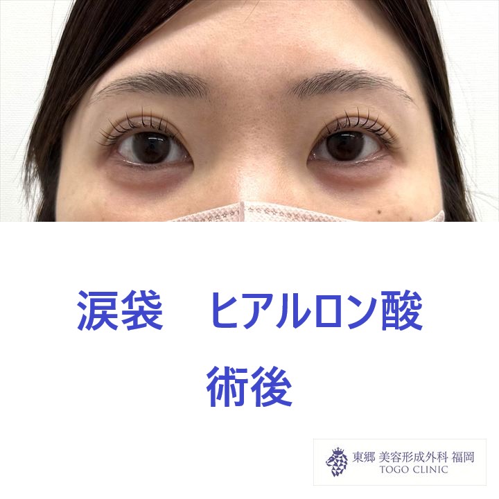 KO　涙袋　術後