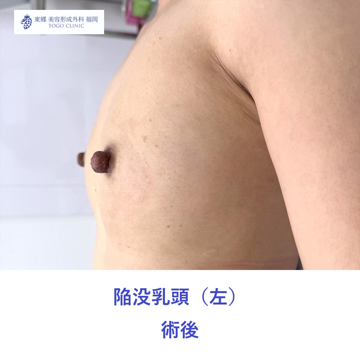 EK　陥没乳頭術後 (2)