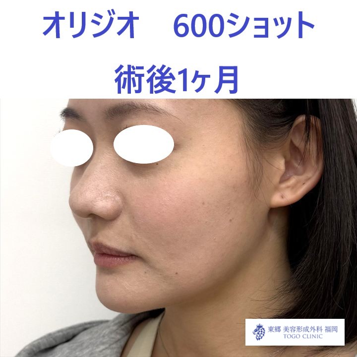 RFオリジオ術後 (2)