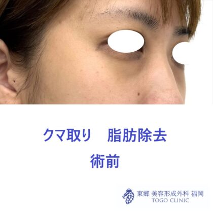 MN　経結膜脱脂術前 (2)