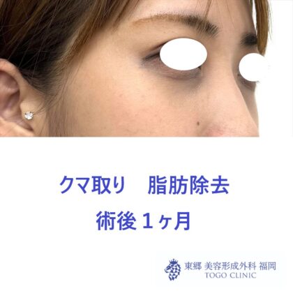 MN　経結膜脱脂術後１M (2)