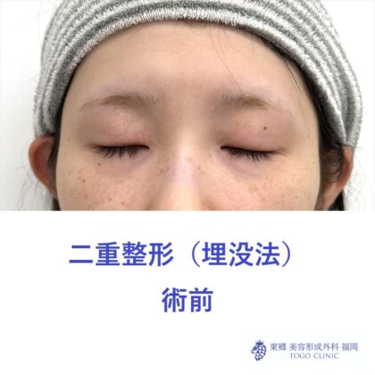 MS　二重埋没術前 (2)