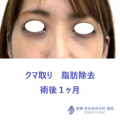MN　経結膜脱脂術後１M