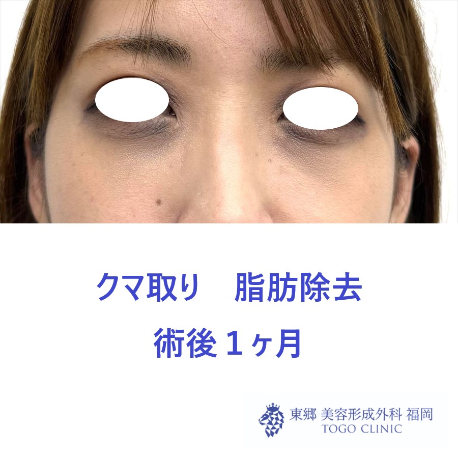 MN　経結膜脱脂術後１M