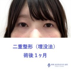 MS　二重埋没術後