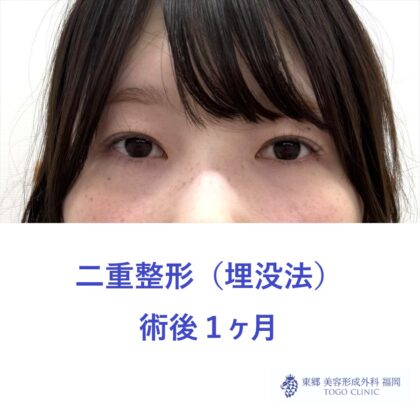 MS　二重埋没術後