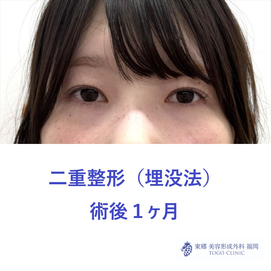 MS　二重埋没術後
