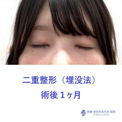 MS　二重埋没術後 (2)