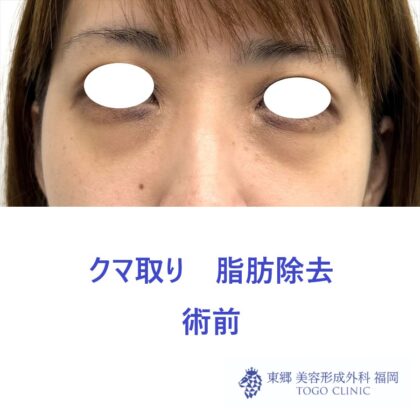 MN　経結膜脱脂術前